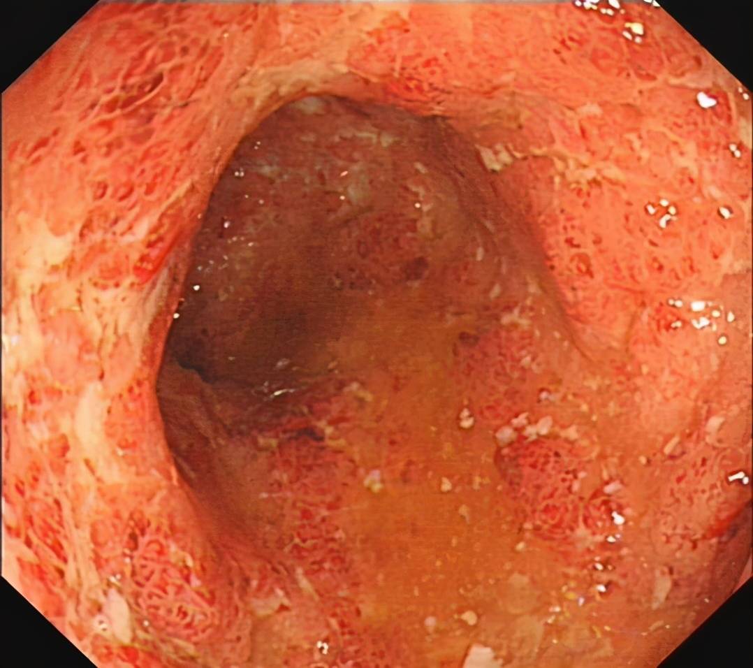 溃疡性结肠炎最新治疗方法揭秘