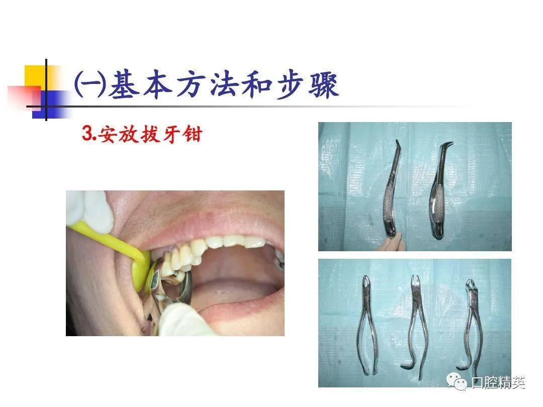 微创拔牙技术，革新你的拔牙体验