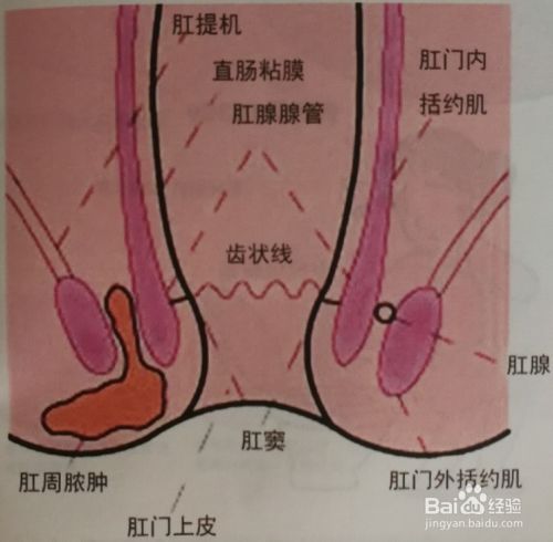 肛瘘最新治疗方法及其探讨